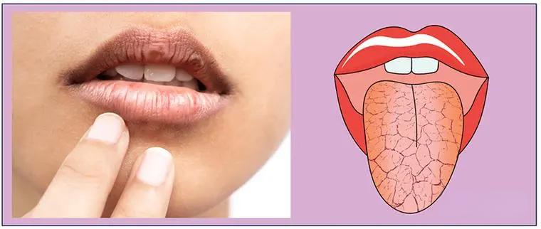 RiboX Therapeutics’ Circular RNA Therapy RXRG001 Gets FDA Green Light for Dry Mouth Clinical Trial