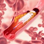 Sino Medical Sciences Technology Secures Marketing Approval for Coronary Balloon Dilation Catheter in Morocco