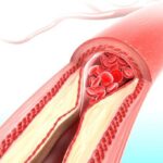Xeltis AG Enrolls First Patient in US Pivotal Trial for aXess with FDA BTD Status