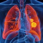 Janssen-Cilag's Lazcluze-Rybrevant Combo Receives Positive EMA Opinion for NSCLC Treatment
