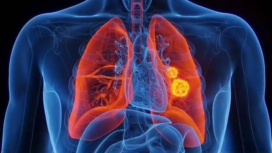 Janssen-Cilag’s Lazcluze-Rybrevant Combo Receives Positive EMA Opinion for NSCLC Treatment