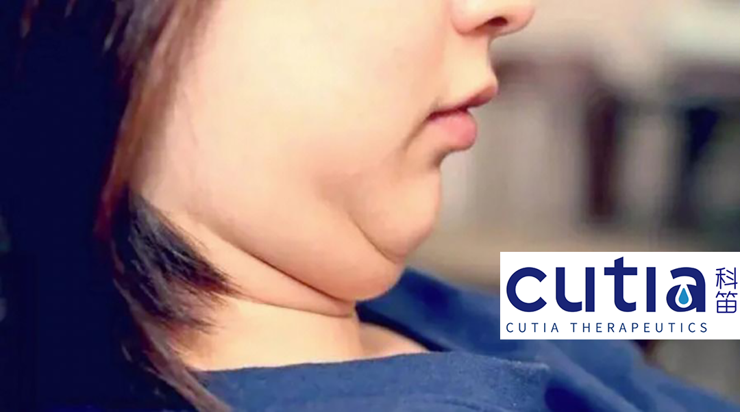 Cutia Therapeutic's CU-20401 Shows Positive Results in Phase II Subcutaneous Fat Reduction Study