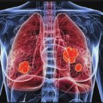 BeyondSpring Presents Positive Phase II Data for Plinabulin Combination Therapy in NSCLC at SITC