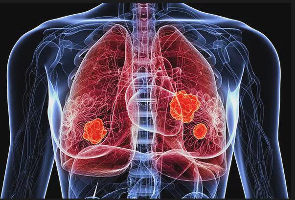 BeyondSpring Presents Positive Phase II Data for Plinabulin Combination Therapy in NSCLC at SITC