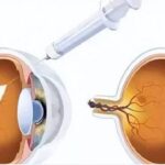 Sandoz Receives EC Approval for Biosimilar to Eylea for Retinal Diseases