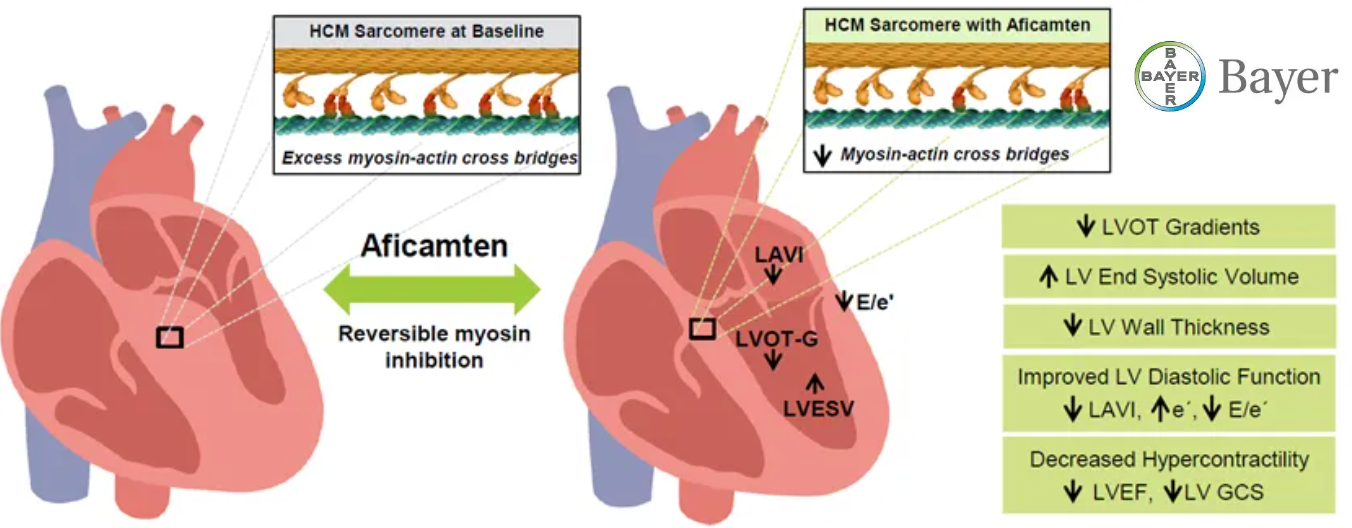 Bayer AG Secures Exclusive Rights to Cytokinetics’ Aficamten in Japan