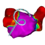 Johnson & Johnson MedTech's Varipulse Platform Receives FDA Approval for Atrial Fibrillation Treatment