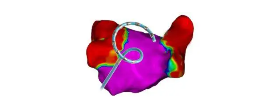 Johnson & Johnson MedTech’s Varipulse Platform Receives FDA Approval for Atrial Fibrillation Treatment