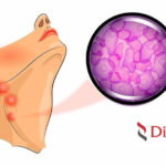 Dizal Pharmaceutical Unveils Promising Data on DZD8586 for B-NHL at ASH Annual Meeting