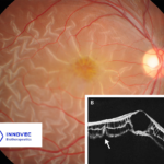 InnoVec Biotherapeutics' IVB102 Receives FDA IND Approval for X-Linked Retinoschisis Treatment