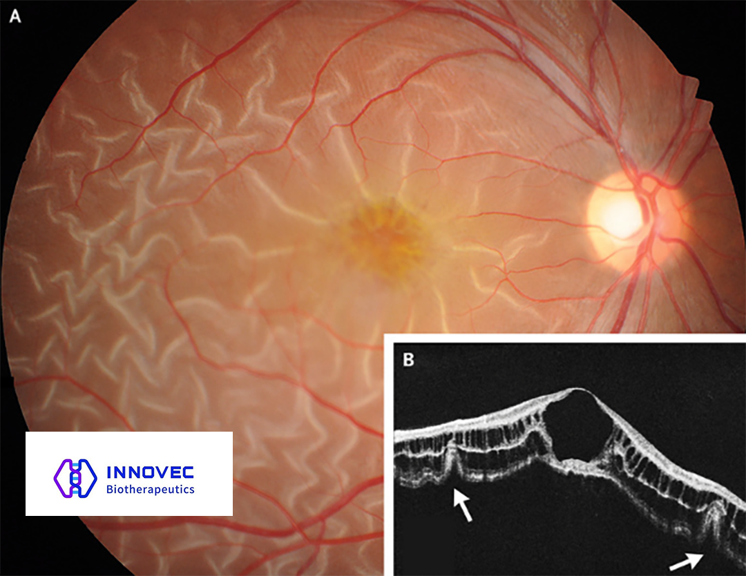 InnoVec Biotherapeutics’ IVB102 Receives FDA IND Approval for X-Linked Retinoschisis Treatment