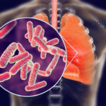 Boji Medical Technology Receives NMPA Approval for TBA Clinical Study in Drug-Resistant Tuberculosis