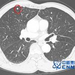 Chia Tai Tianqing's Benmelstobart and Anlotinib Combo Meets Primary Endpoint in Phase III Study