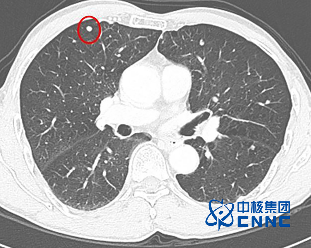 Chia Tai Tianqing's Benmelstobart and Anlotinib Combo Meets Primary Endpoint in Phase III Study