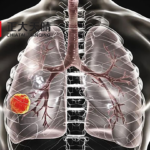 Chia Tai Tianqing's Benmelstobart and Anlotinib Combo Meets Primary Endpoint in Phase III Study