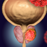 Hinova Pharmaceuticals Enrolls First Patient in Phase II Study for HP518 in mCRPC
