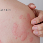 Johnson & Johnson Secures Licensing Deal with Kaken Pharmaceutical for STAT6 Program