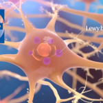 UCB's Minzasolmin Fails to Meet Endpoints in ORCHESTRA Study for Early Parkinson's
