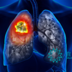 MediLink Therapeutics' YL201 Receives FDA Orphan Drug Designation for Small-Cell Lung Cancer