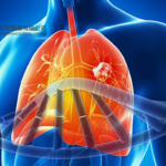 Sino Biopharmaceutical's Benmelstobart Meets Primary Endpoint in Phase III NSCLC Study