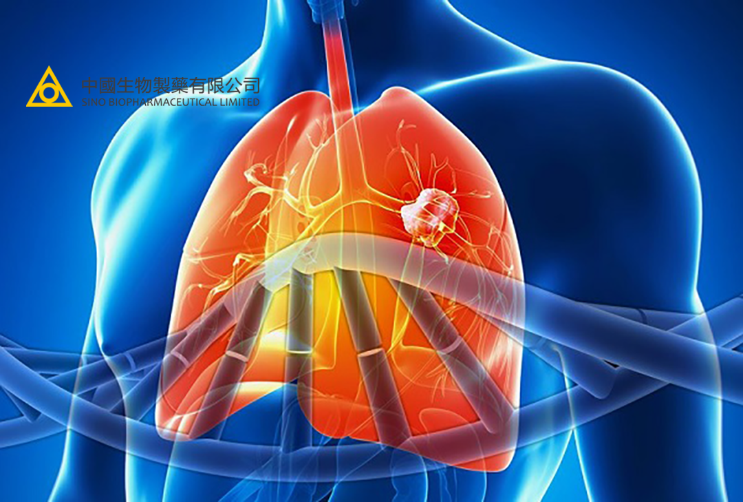 Sino Biopharmaceutical's Benmelstobart Meets Primary Endpoint in Phase III NSCLC Study