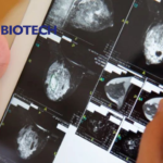 Sichuan Kelun-Biotech Launches Sacituzumab Tirumotecan for Triple Negative Breast Cancer in China