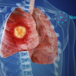 Nuvation Bio's Taletrectinib NDA for ROS1+ NSCLC Receives FDA Priority Review