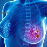 Hinova Pharmaceuticals' HP568 Earns FDA Clinical Trial Approval for ER+/HER2- Breast Cancer