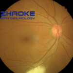 Zhaoke Ophthalmology's TAB014 Achieves Positive Phase III Results for wAMD