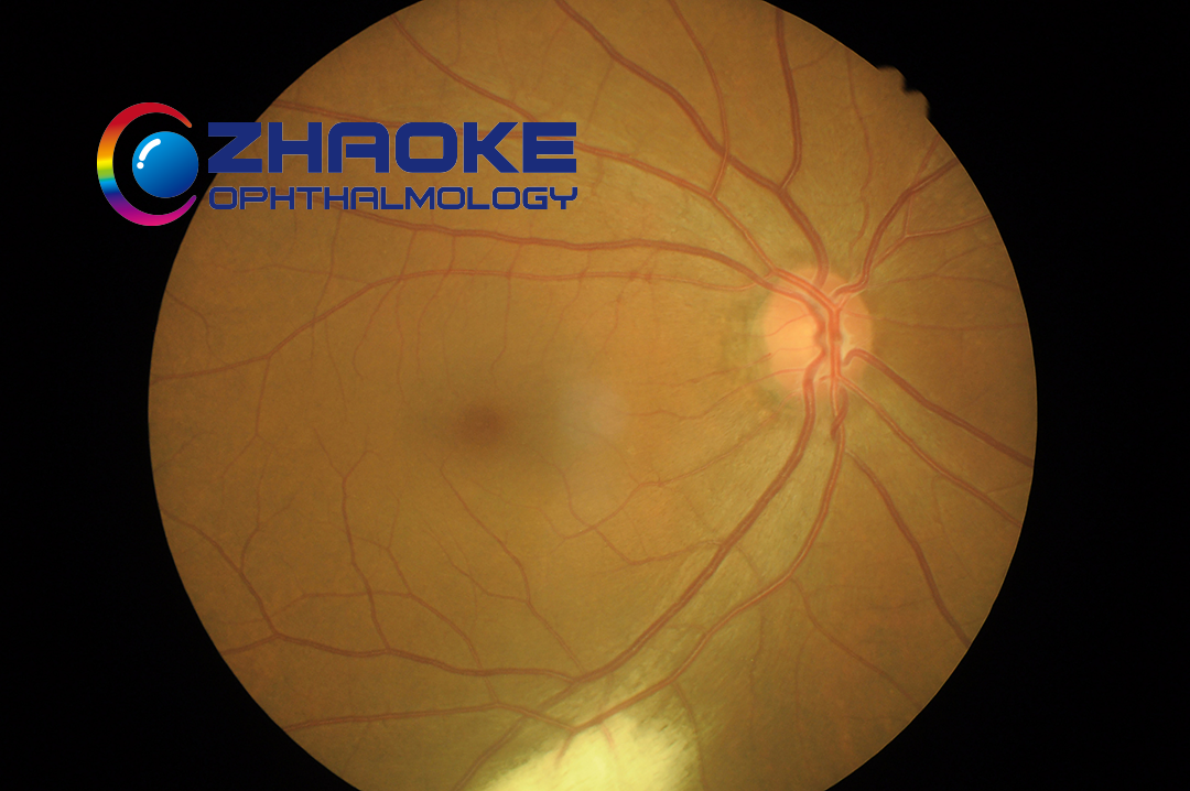 Zhaoke Ophthalmology’s TAB014 Achieves Positive Phase III Results for wAMD