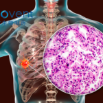 Innovent Biologics Strikes Licensing Deal with Roche for IBI3009 ADC