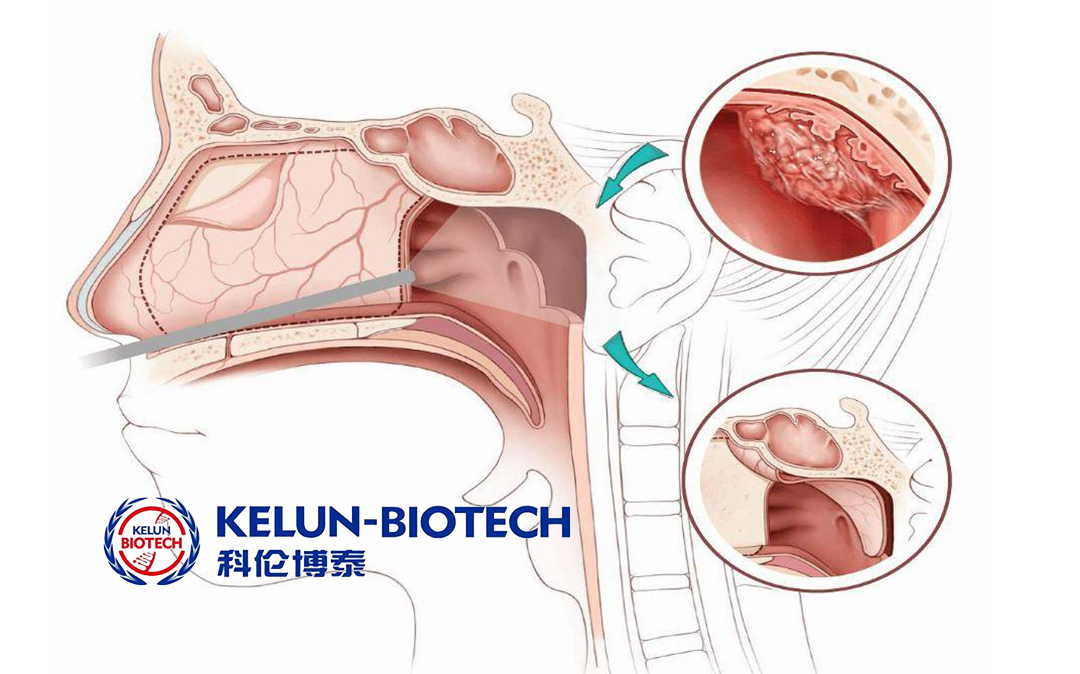 Sichuan Kelun-Biotech's Ketailai Receives NMPA Approval for Nasopharyngeal Carcinoma Treatment