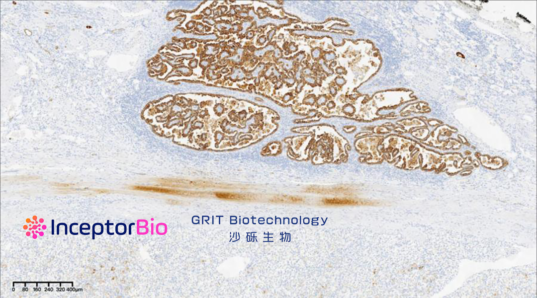 Inceptor Bio and GRIT Biotechnology Partner to Advance CAR-T Therapy IB-T101 for Solid Tumors