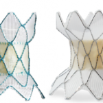 Medtronic's Harmony TPV System Gains CE Mark for Minimally Invasive Heart Valve Treatment