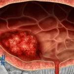 Mabwell's 9MW2821 Granted Breakthrough Therapy Designation by CDE for Urothelial Carcinoma
