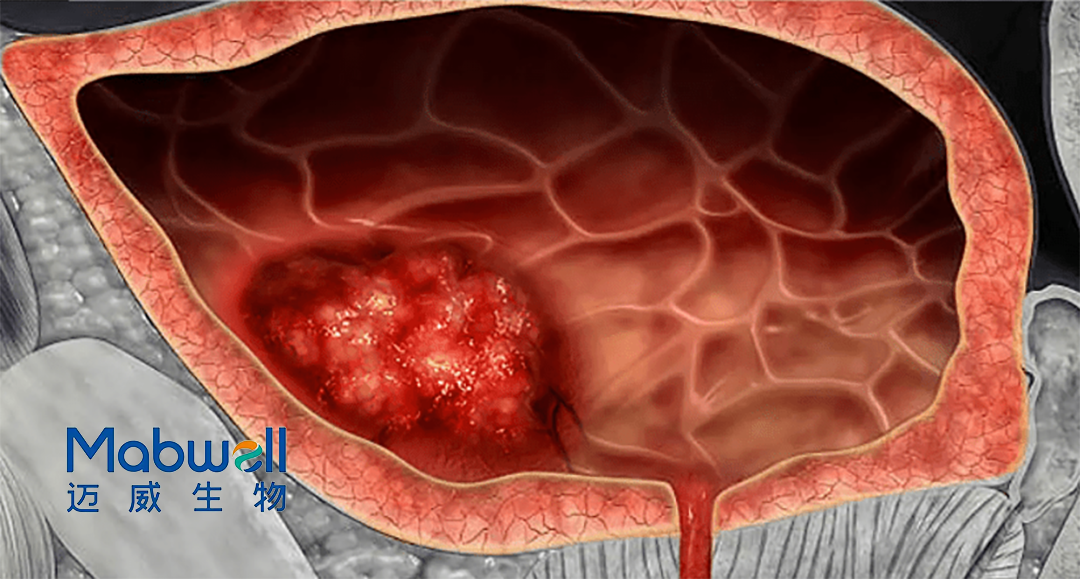 Mabwell's 9MW2821 Granted Breakthrough Therapy Designation by CDE for Urothelial Carcinoma