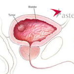Astellas' Padcev and Keytruda Combo Cleared by NMPA for Urothelial Cancer