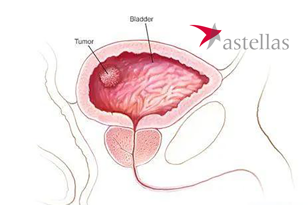 Astellas' Padcev and Keytruda Combo Cleared by NMPA for Urothelial Cancer