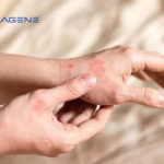 Inmagene Biopharmaceuticals Posts Positive Results for IMG-007 in Atopic Dermatitis