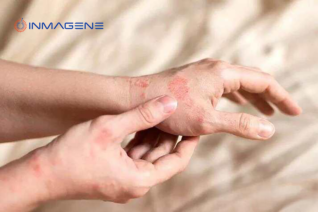 Inmagene Biopharmaceuticals Posts Positive Results for IMG-007 in Atopic Dermatitis