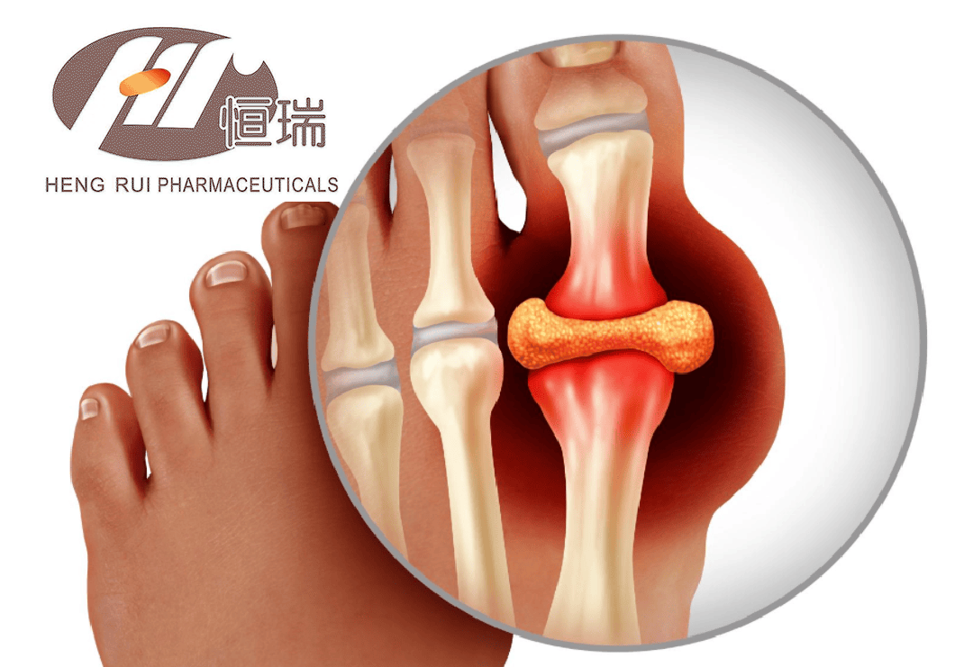 Hengrui's SHR4640 Accepted for NMPA Review for Gout and Hyperuricemia Treatment