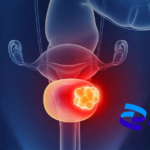 Pfizer's Sasanlimab Shows Positive Results in Phase III CREST Study
