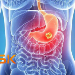 GSK Acquires IDRx for $1B to Boost GIST Treatment Pipeline