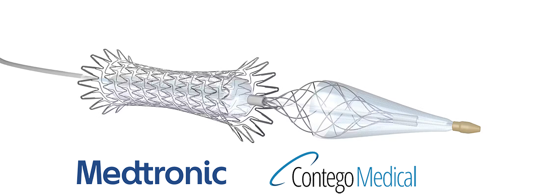 Medtronic Secures Exclusive Distribution Rights for Contego's Neuroguard and Excipio