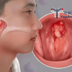 Junshi Biosciences' Toripalimab Gains TGA Approval for Nasopharyngeal Carcinoma