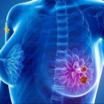 FDA Approves Datroway for HR+/HER2- Breast Cancer Treatment