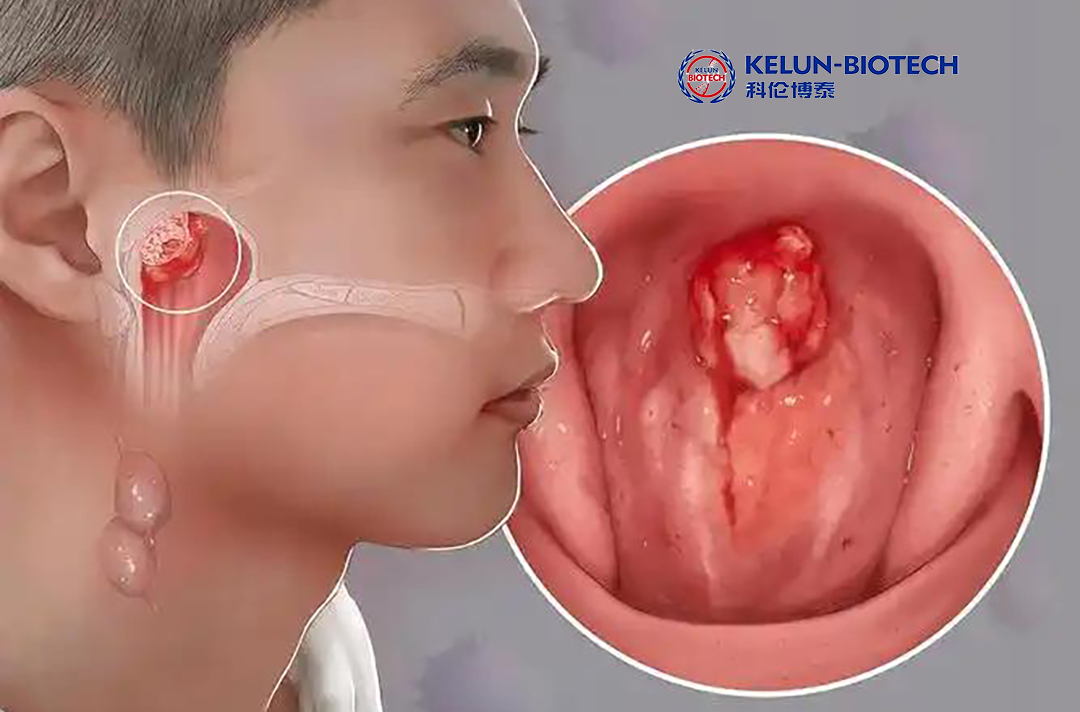 Kelun-Biotech's Tagitanlimab Receives NMPA Clearance for Nasopharyngeal Carcinoma