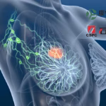 Alphamab and CSPC Gain NMPA Approval for JSKN003 Phase III Trial in HER2-Positive Breast Cancer