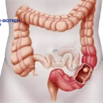 Sichuan Kelun-Biotech's Datailai Gains NMPA Approval for Colorectal Cancer Treatment