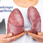 Boehringer Ingelheim's Nerandomilast Hits Primary Endpoint in PPF Phase III Study